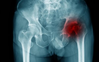 Compensation for Hip Injuries Under the Defense Base Act